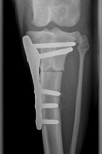 TPLO surgery xray