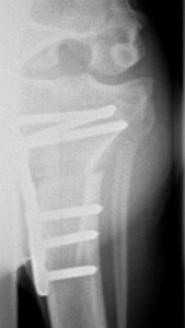 AP TLPO xray