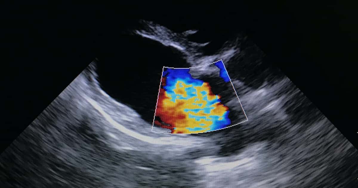ultrasound heart murmur