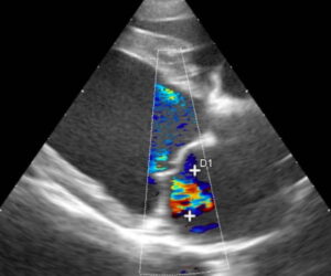 dilated cardiomyopathy ultrasound